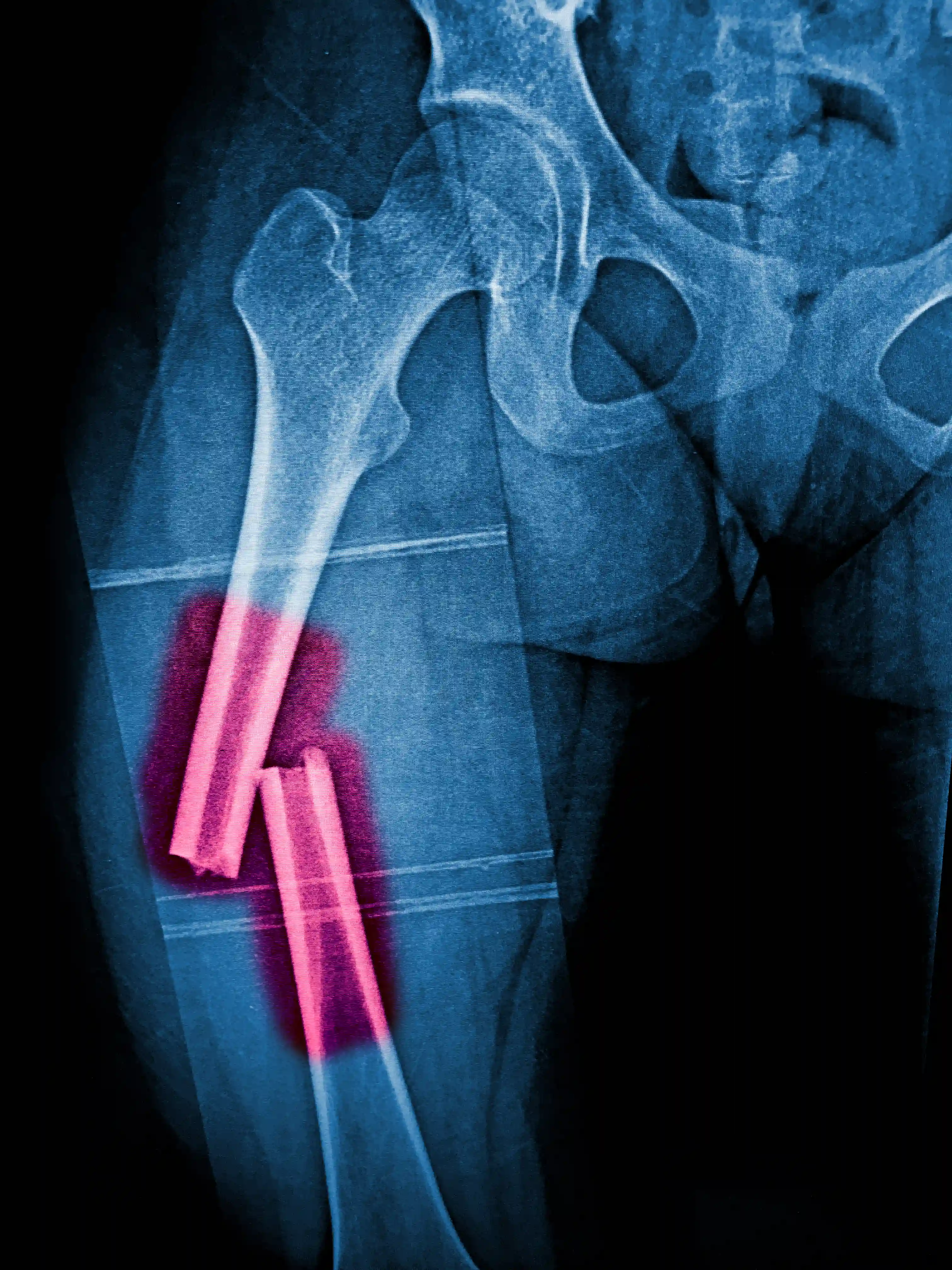 Complex Joint Reconstruction